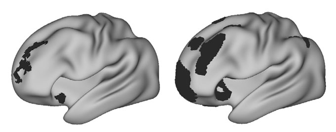 Two brains are shown in gray from the side. The one on the left has black spots in a few areas, while the one on the right has larger black blobs in similar regions