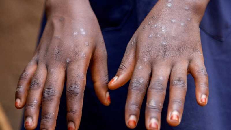 Mpox cases continue to rise in Africa