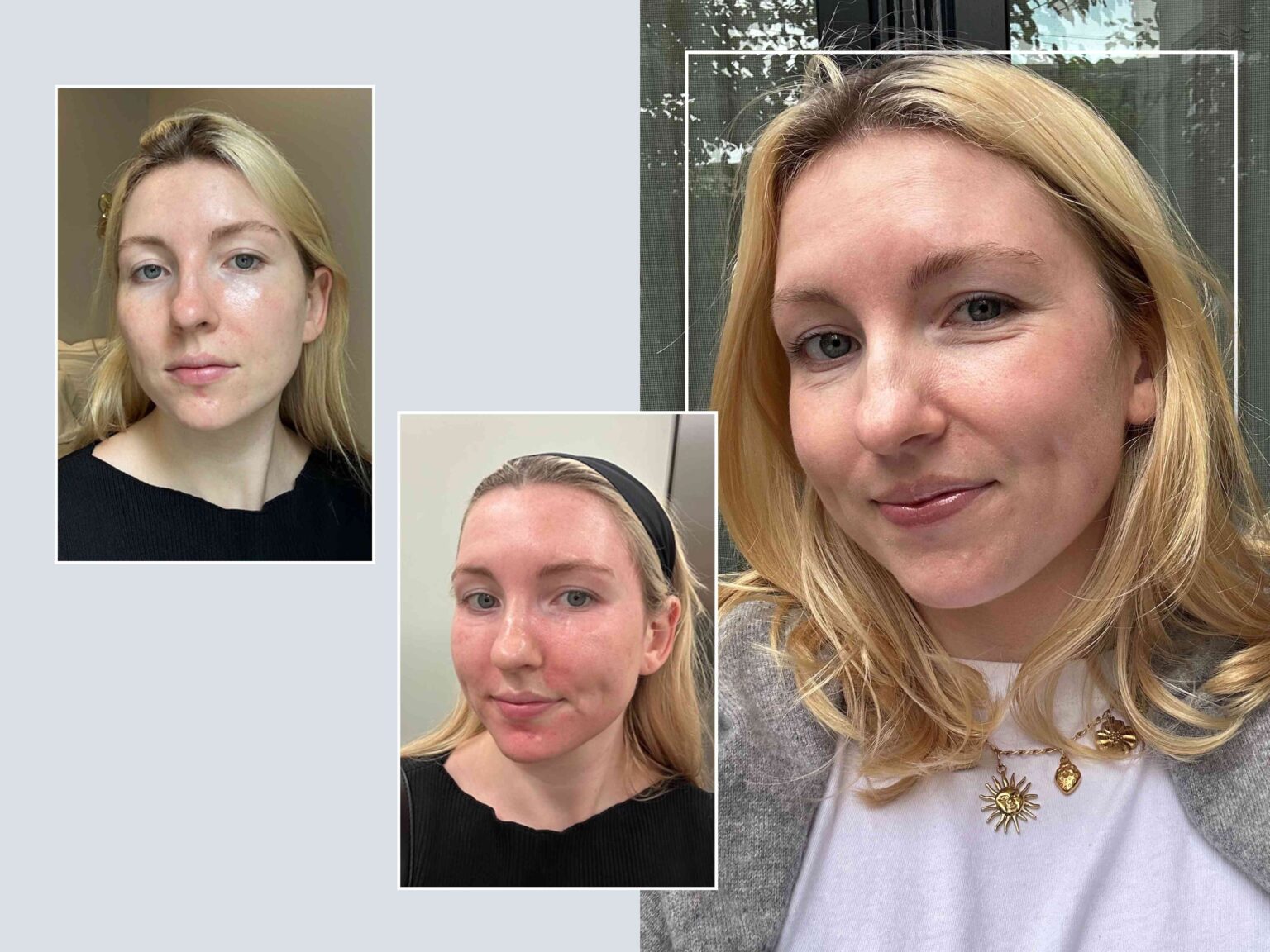 I Tried Fractional Laser for Acne Scars—Here's My Full Review of the Popular Treatment