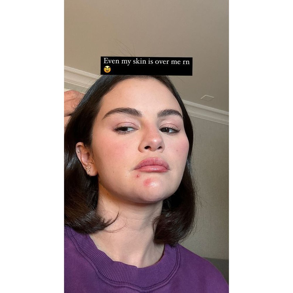 Selena Gomez Shares Candid Acne Selfie